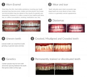 Dental-Veneers