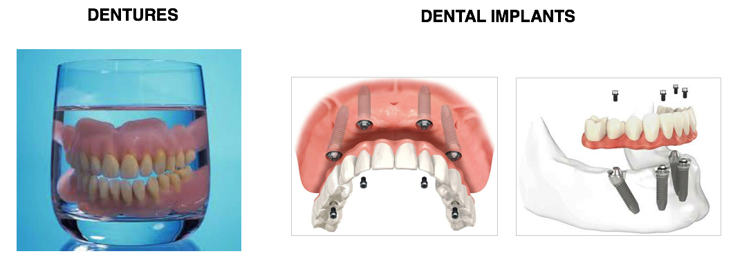 Dental Implants Against Dentures