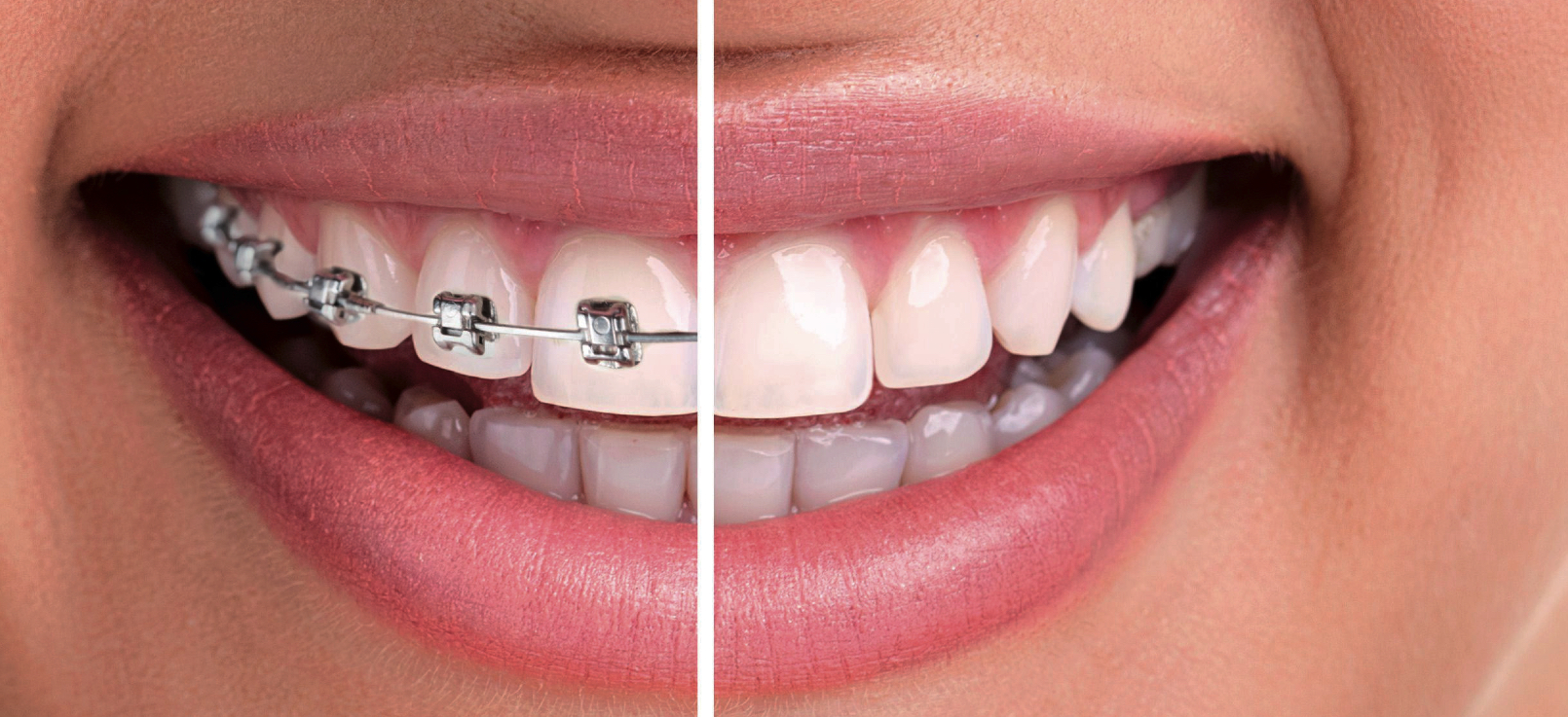 ¿Qué es la ortodoncia invisible «Invisalign»?