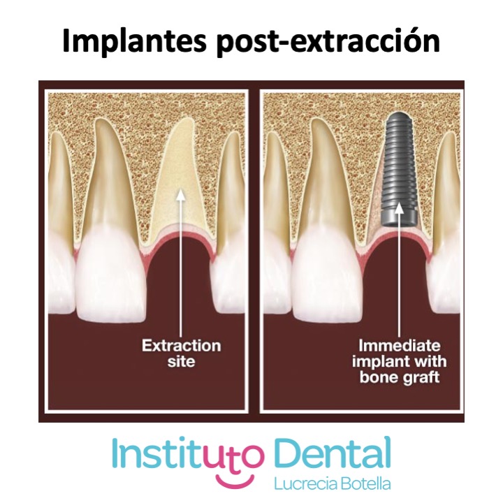Implante post-extracción