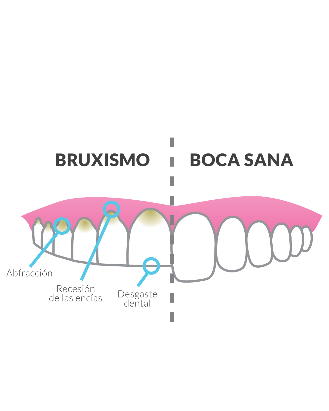 Bruxismo nocturno: cómo evitar el desgaste dental | Clínica Dental en Torrevieja