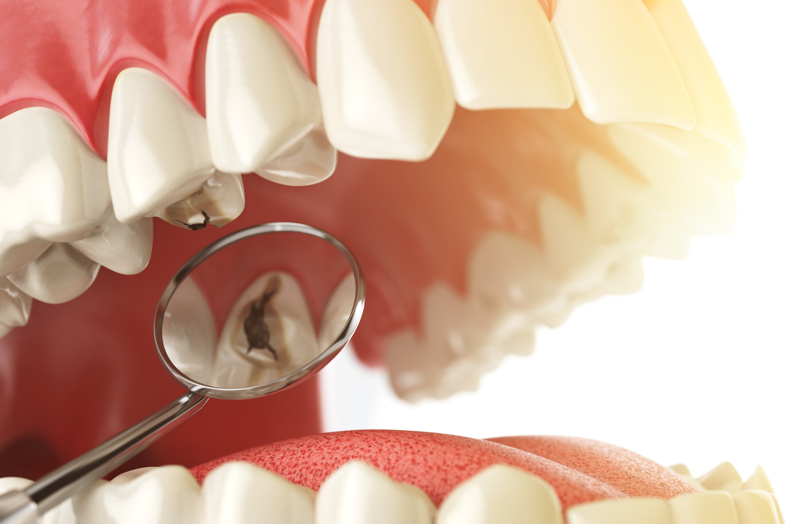 Tratamiento de una caries en la Clínica dental Lucrecia Botella de Torrevieja